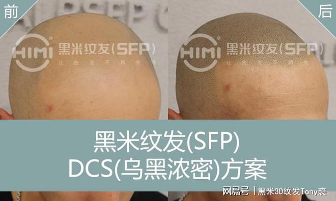 凯发K8娱乐平台游戏下载|不植发选纹发：